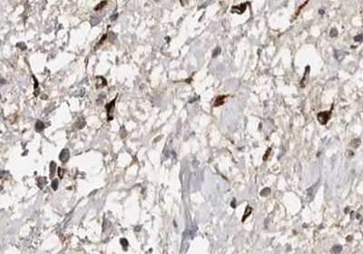 Fibroblasts and Connective Tissue Cells Immunohistochemical staining of Serpin Peptidase Inhibitor, or Heat Shock Protein 47