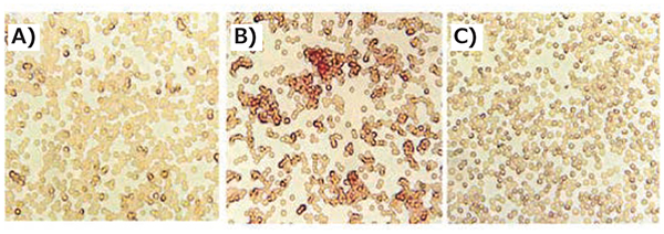 Incorporation of transferrin decreases erythrocyte aggregation Incorporation of transferrin decreases erythrocyte aggregation