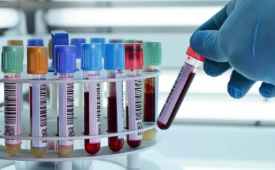 A gloved hand places a test tube holding a blood sample into a plastic laboratory test tube rack holding other blood samples with various colored lids