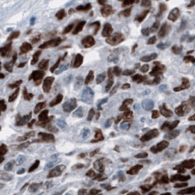 Immunohistochemical staining of human germinal cells in embryonal testis carcinoma using Anti-SALL4 monoclonal antibody (Product No. AMAb91769) showing nuclear positivity.