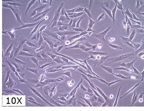 SF8628 Human DIPG H3.3-K27M Cell Line SF8628 pediatric diffuse intrinsic pontine glioma (DIPG) cell line harbors the histone H3.3 Lys 27-to-methionine (K27M) mutation and can support research and drug development efforts targeting DIPG.