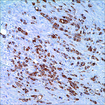 GCDFP-15 (23A3) + Mammaglobin Cocktail (304-1A5 &amp; 31A5) Mouse/Rabbit Monoclonal Antibodies